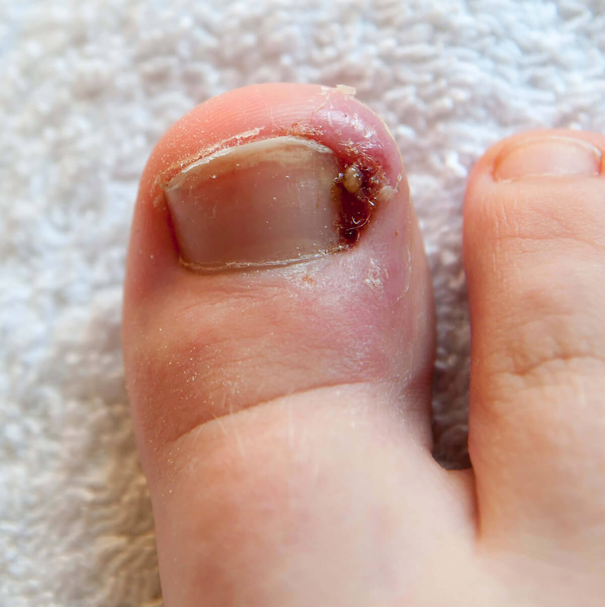Ingrown toenail before treatment