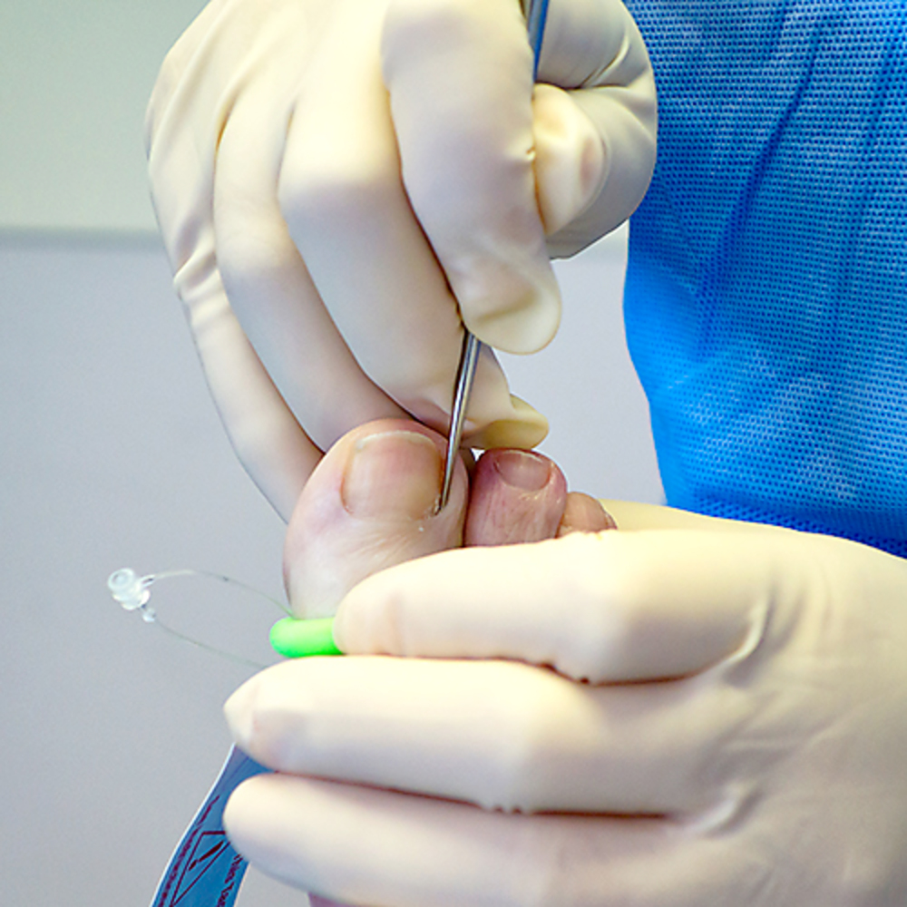 Clinical nail surgery procedure